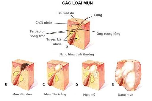 nguyen-nhan-gay-mun-trung-ca-1